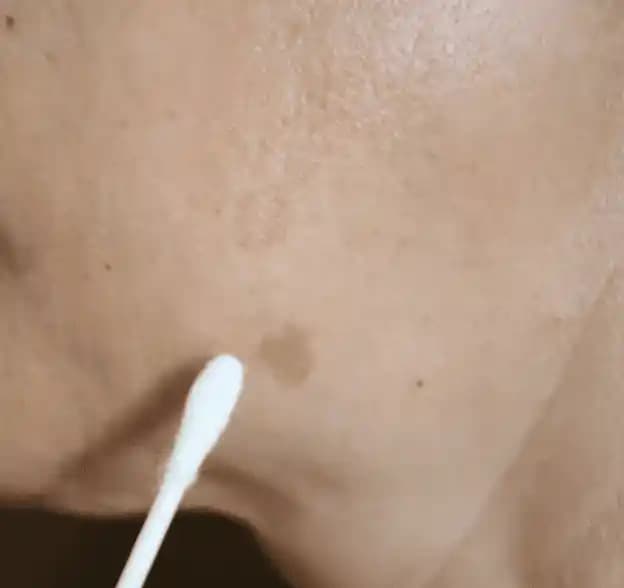 Yüzdeki Lekeleri Doğal Yöntemlerle Gidermenin Etkili ve Sağlıklı Yolları