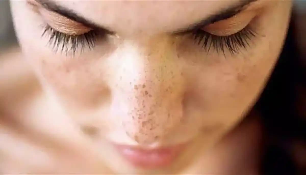 Yüzdeki Siyah Lekeler: Nedenleri, Etkili Tedavi Yöntemleri ve Koruyucu Öneriler