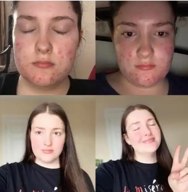 Zoretanin ile Cilt Bakımında Devrim: Akne ve Lekelerde Etkili Çözüm Yöntemi