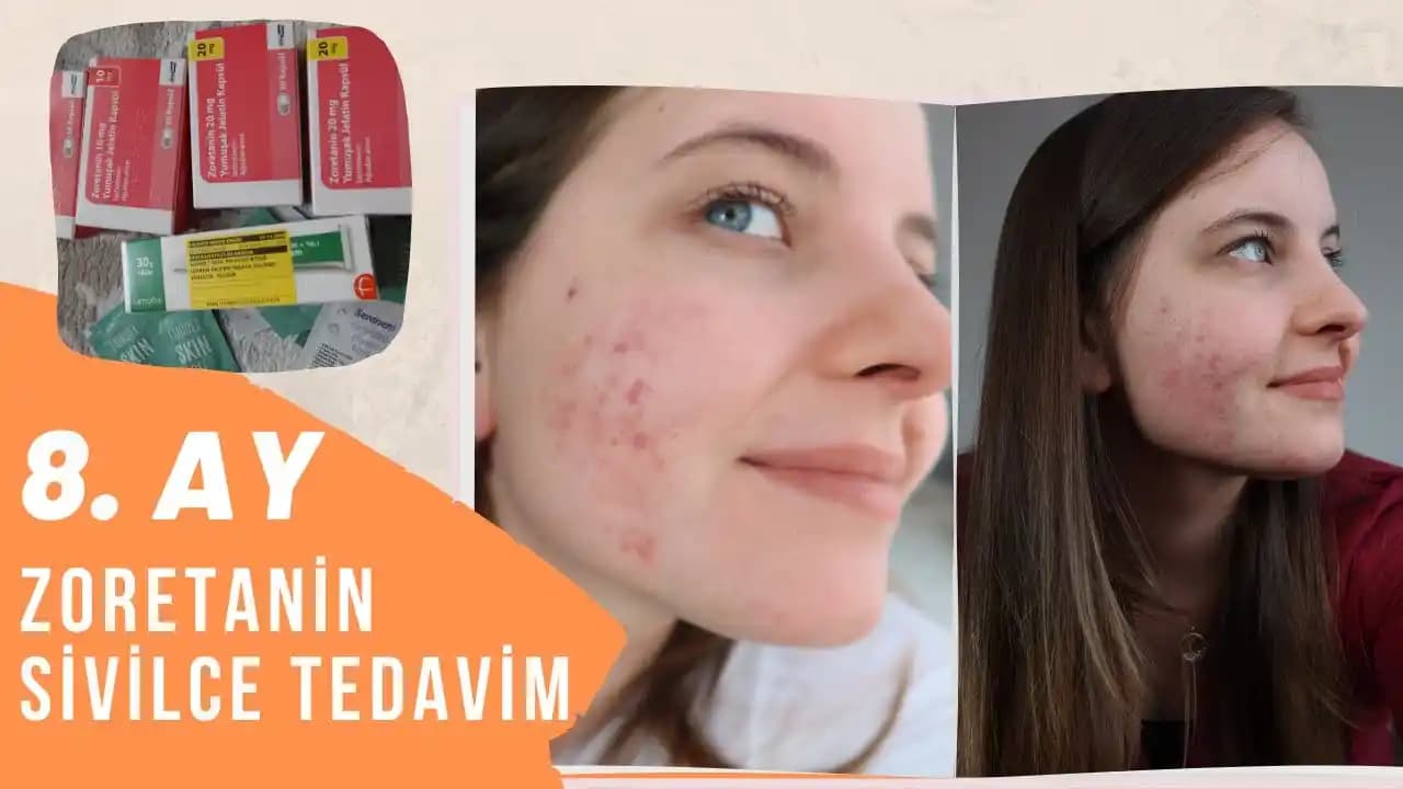 Zoretanin Sonrası Ciltte Leke Tedavisi: Etkili Yöntemler ve Bakım Önerileri