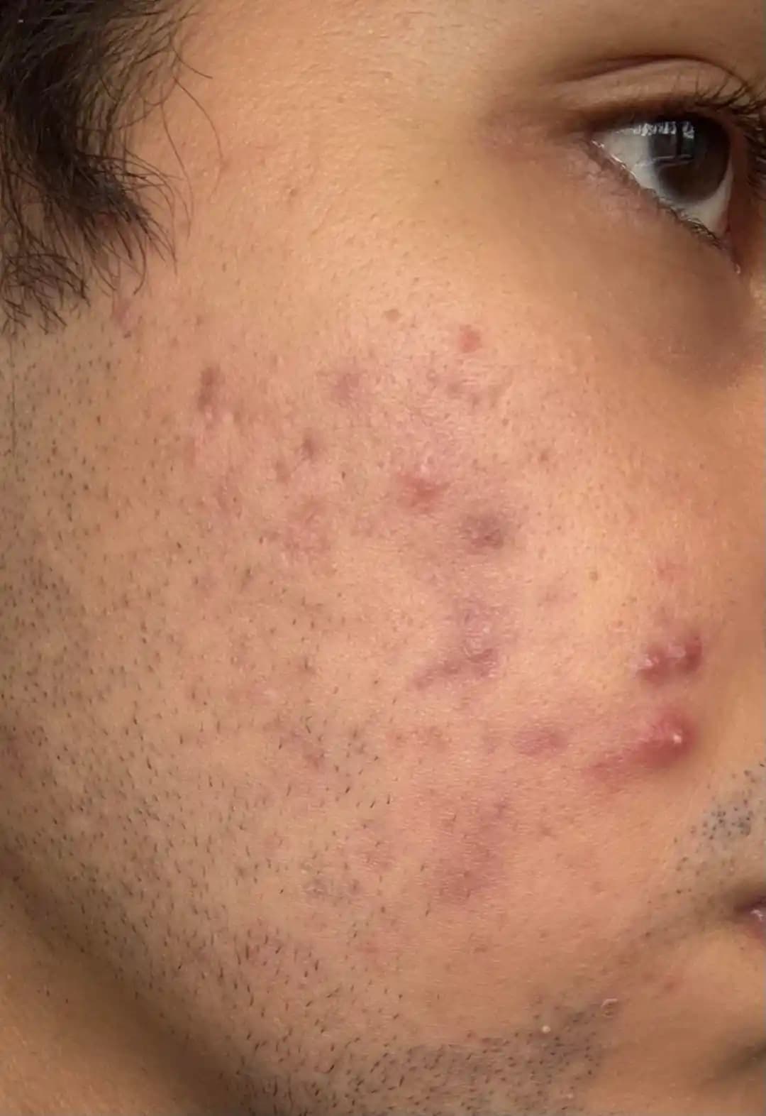 Akne ve Akne Sonrası İzlerin Evde Bakım Yöntemleri ve Cilt Sağlığı