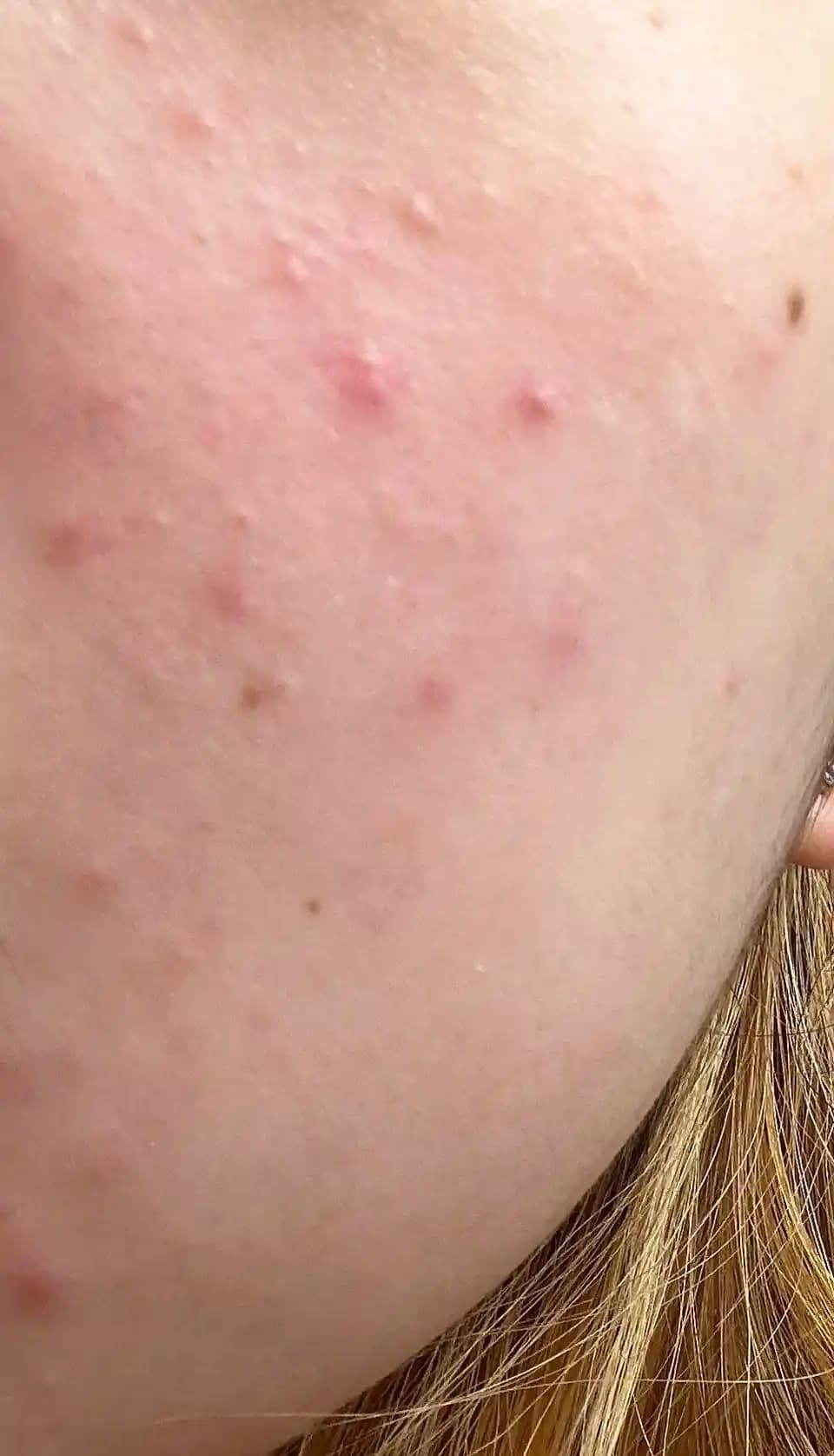 Ani Sivilce Çıkışlarının Nedenleri ve Etkili Çözüm Yöntemleri Üzerine İnceleme