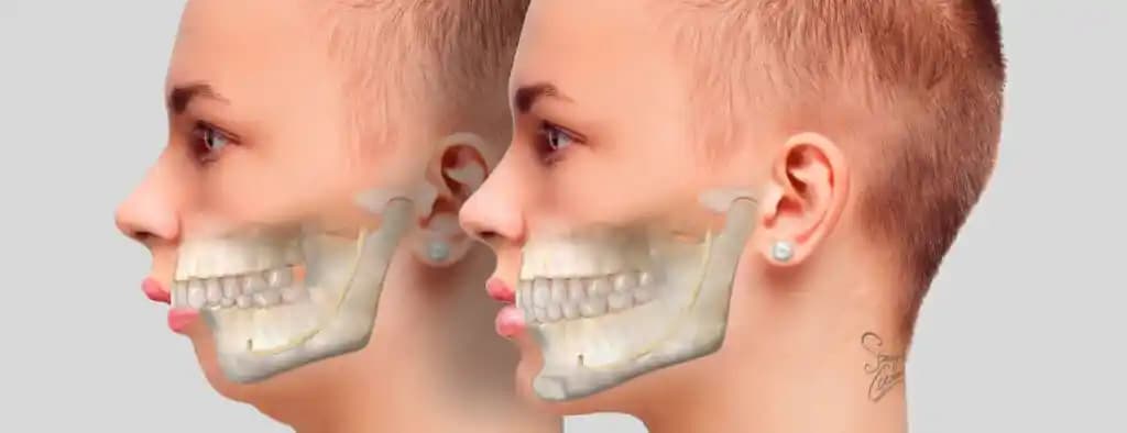 Çift Çene Problemi: Nedenleri, Egzersizler ve Estetik Çözümler Üzerine Kapsamlı İnceleme