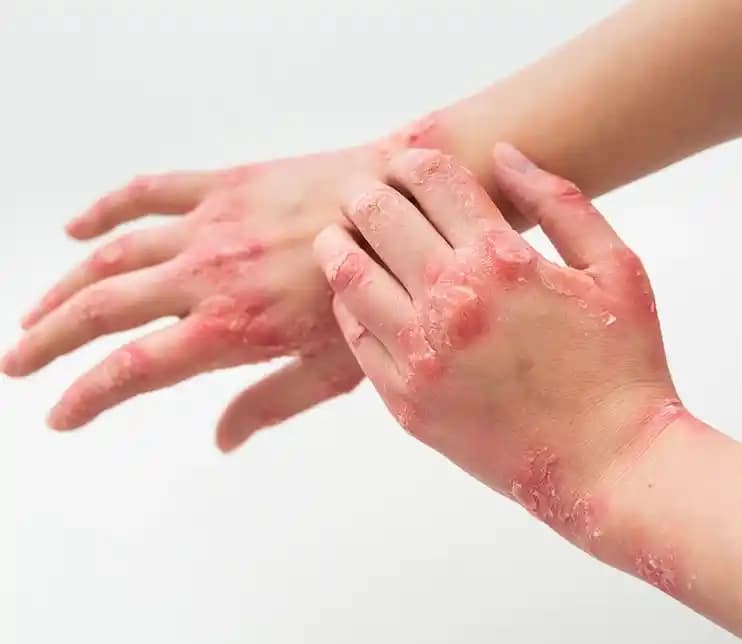 Egzama Tedavisinde Uygun Cilt Bakım Ürünleri ve Etkili Tedavi Yöntemleri