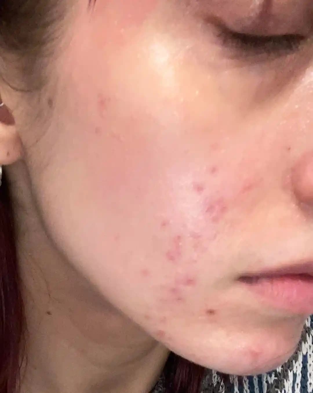 Hasar Görmüş Cilt Bariyeri ve Milia Oluşumunu Önlemede Etkili Yöntemler