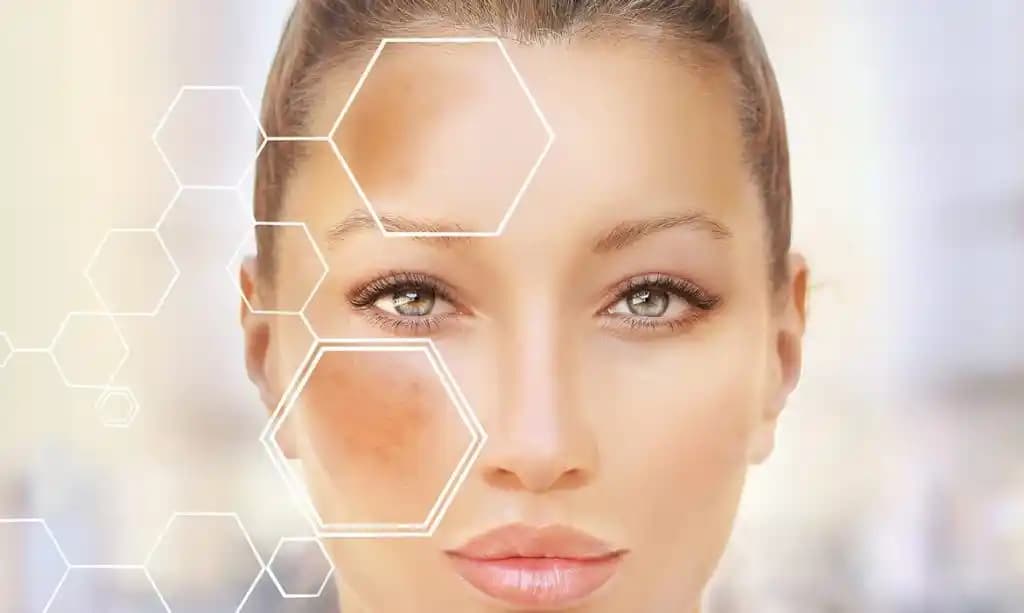 Hassas Karma Ciltlerde Hiperpigmentasyon, Gözenek ve Yağlı T Bölgesi İçin Etkili Ürün Seçimi