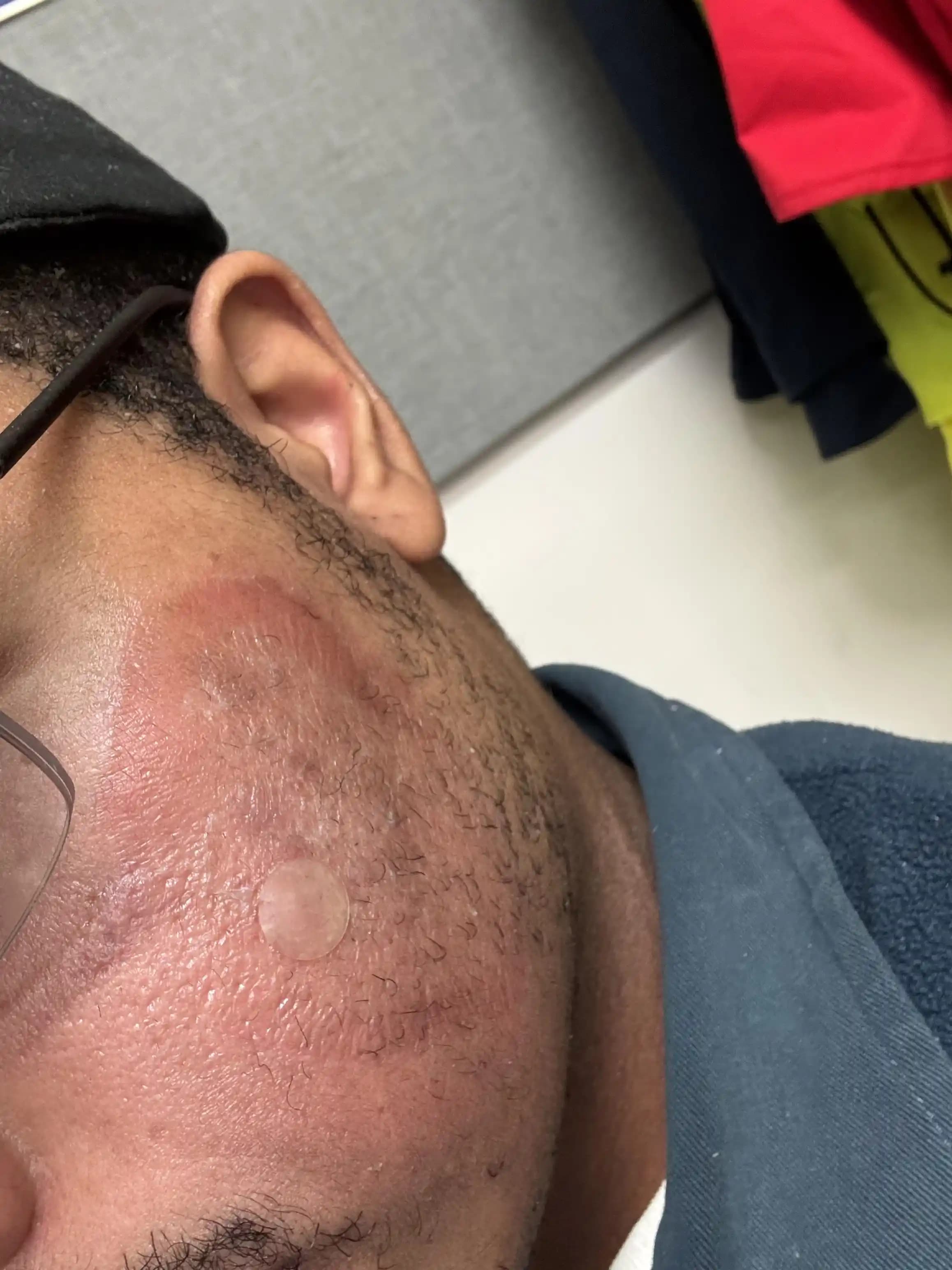 Kimyasal Yanık ve Hasar Görmüş Cilt Bariyerinin Onarımı İçin Etkili Yöntemler