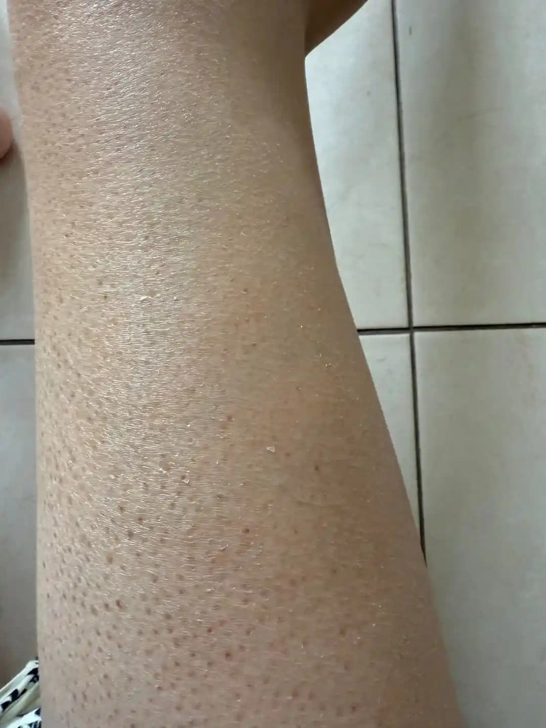 Kronik Kuru Cilt Sorunları ve Yönetimi: Dermatolojik Değerlendirme ve Evde Bakım Yöntemleri