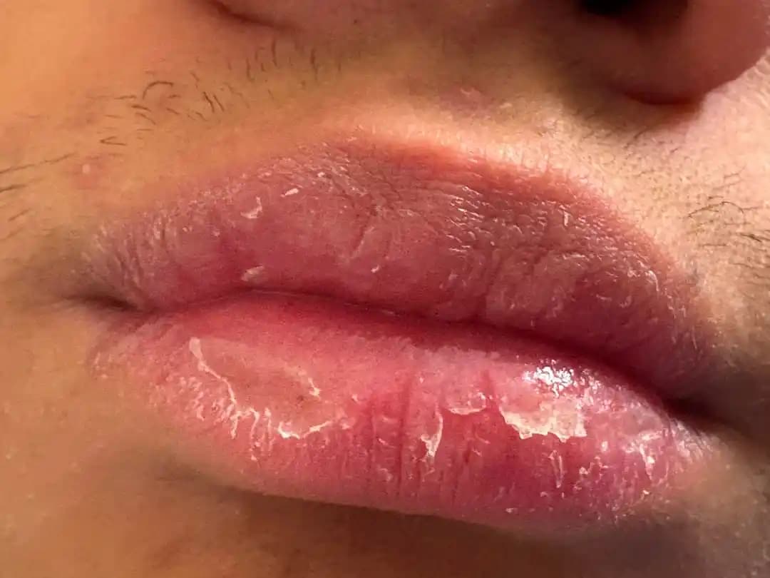 Kronik Kuruyan Dudakların Nedenleri ve Etkili Çözüm Yöntemleri