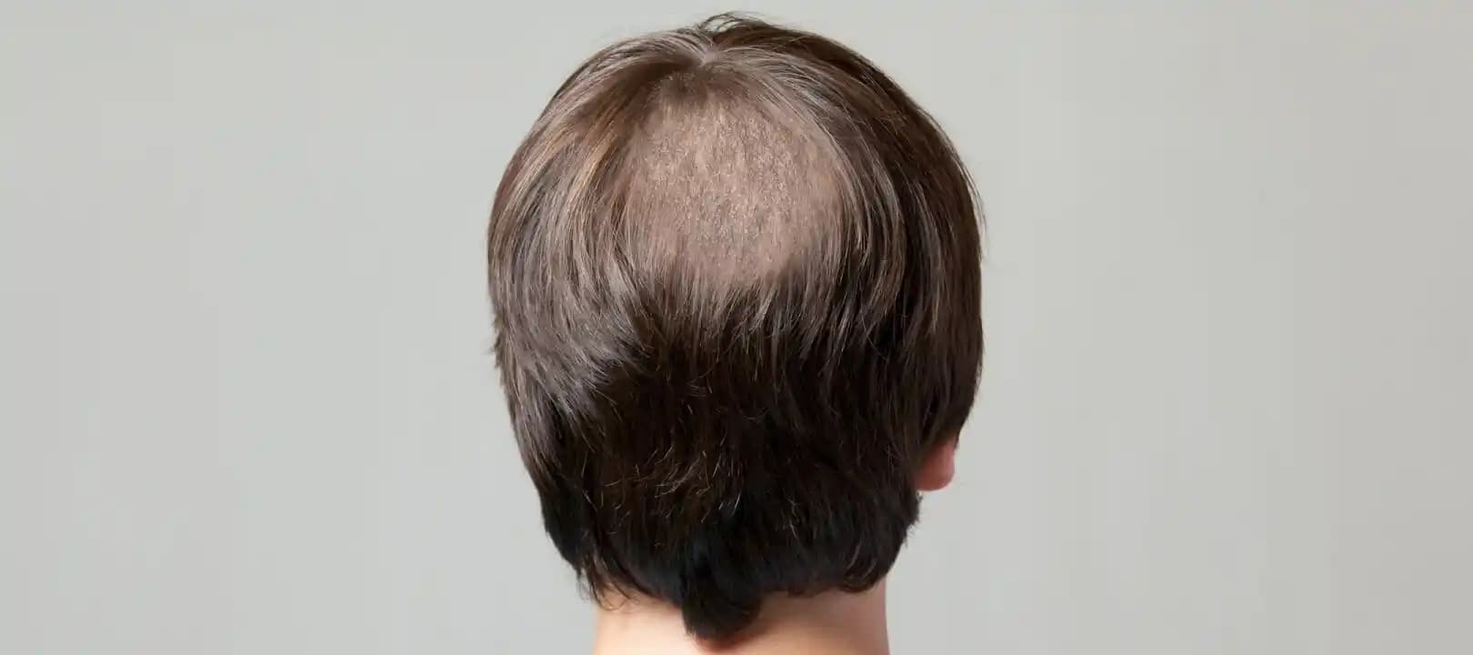 Saçta Kötü Koku Problemi: Mantar Enfeksiyonu ve Diğer Nedenlerin Analizi