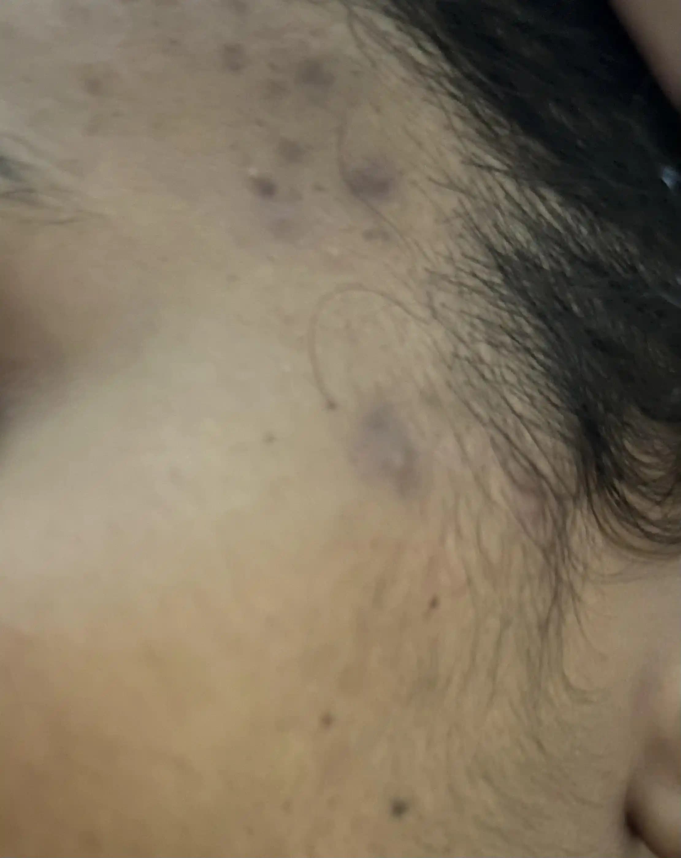 Şakak Bölgesindeki Sivilce Nedenleri ve Saç Ürünlerinin Etkisi Üzerine İnceleme