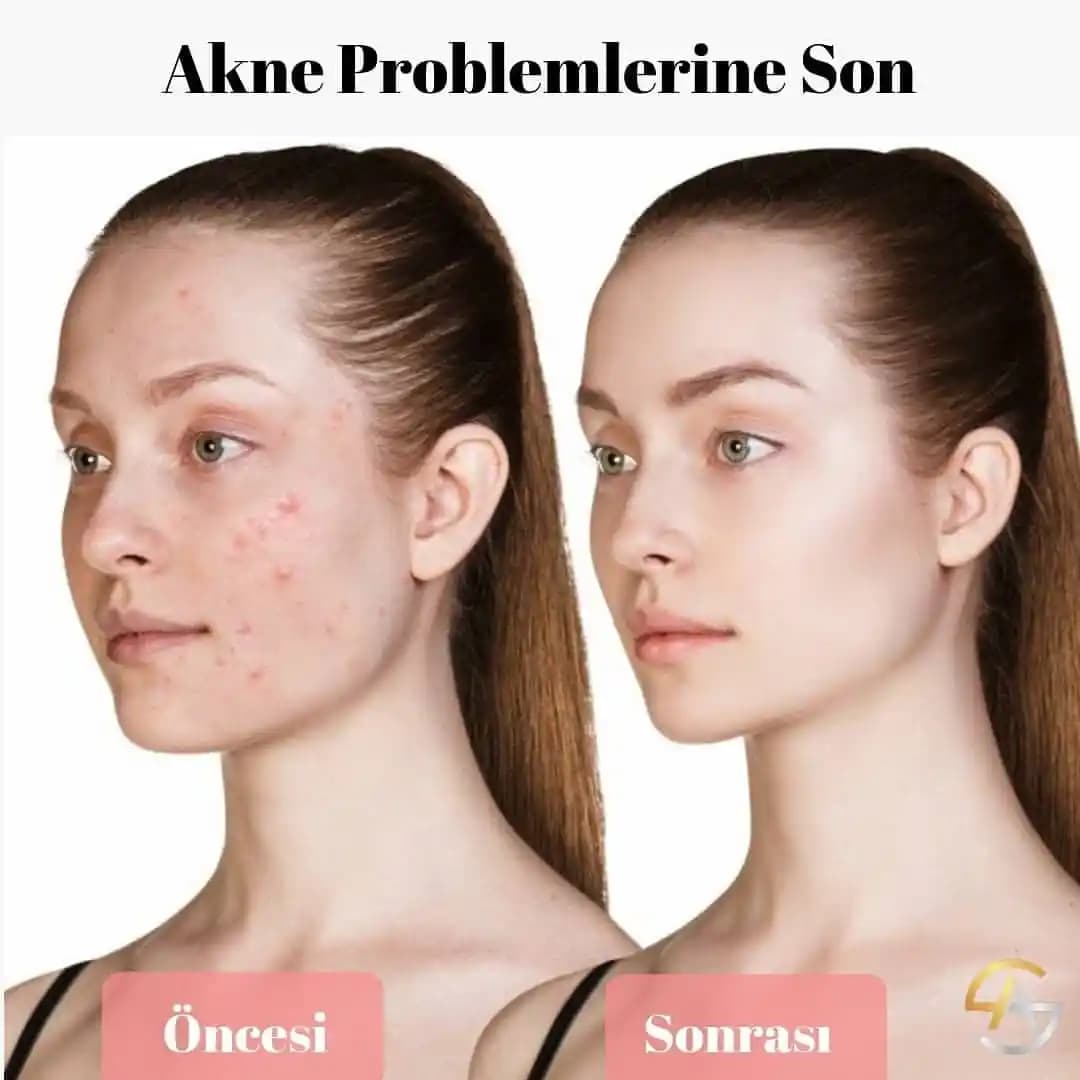 Tretinoin Kullanımıyla Akne İzlerinin Tedavisinde Etkili Yöntemler ve Destekleyici Ürünler