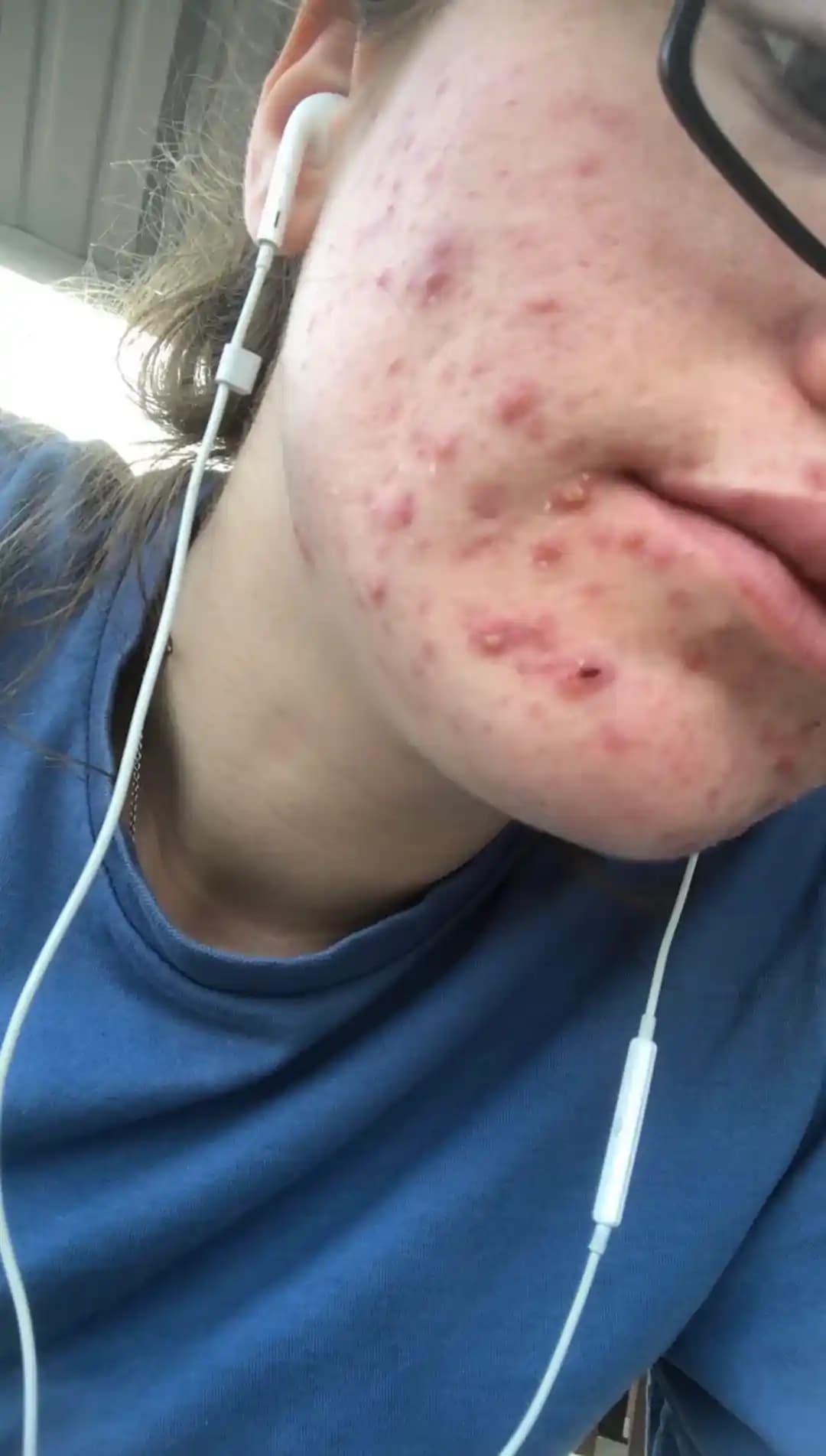 Accutane Tedavisi Öncesi ve Sonrası Cilt Bakım Rutinleri ve Deneyimleri