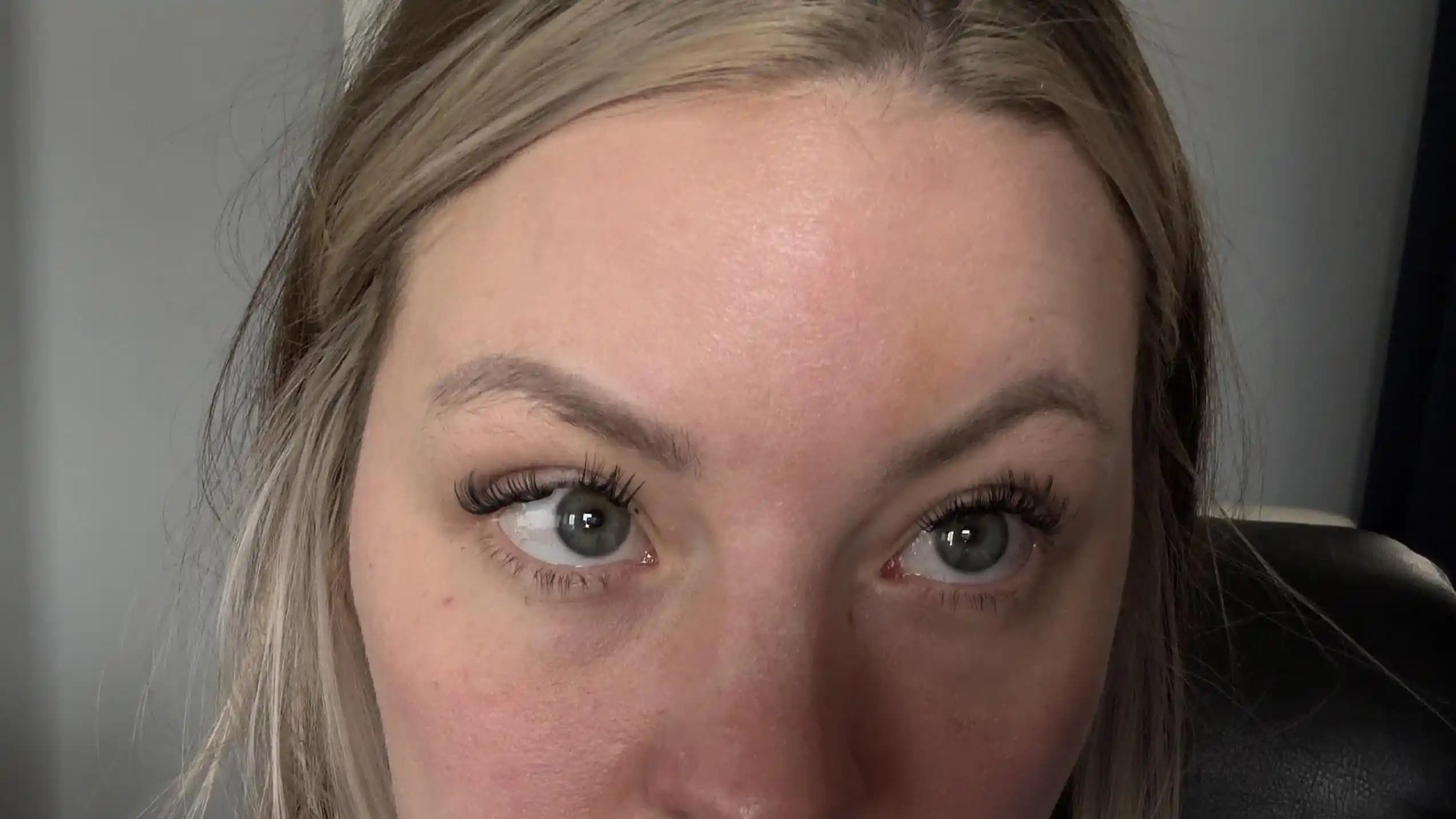 Botoks Sonrası Kaş Yüksekliği: Nedenleri, Düzeltme Yöntemleri ve Estetik Değerlendirmeler