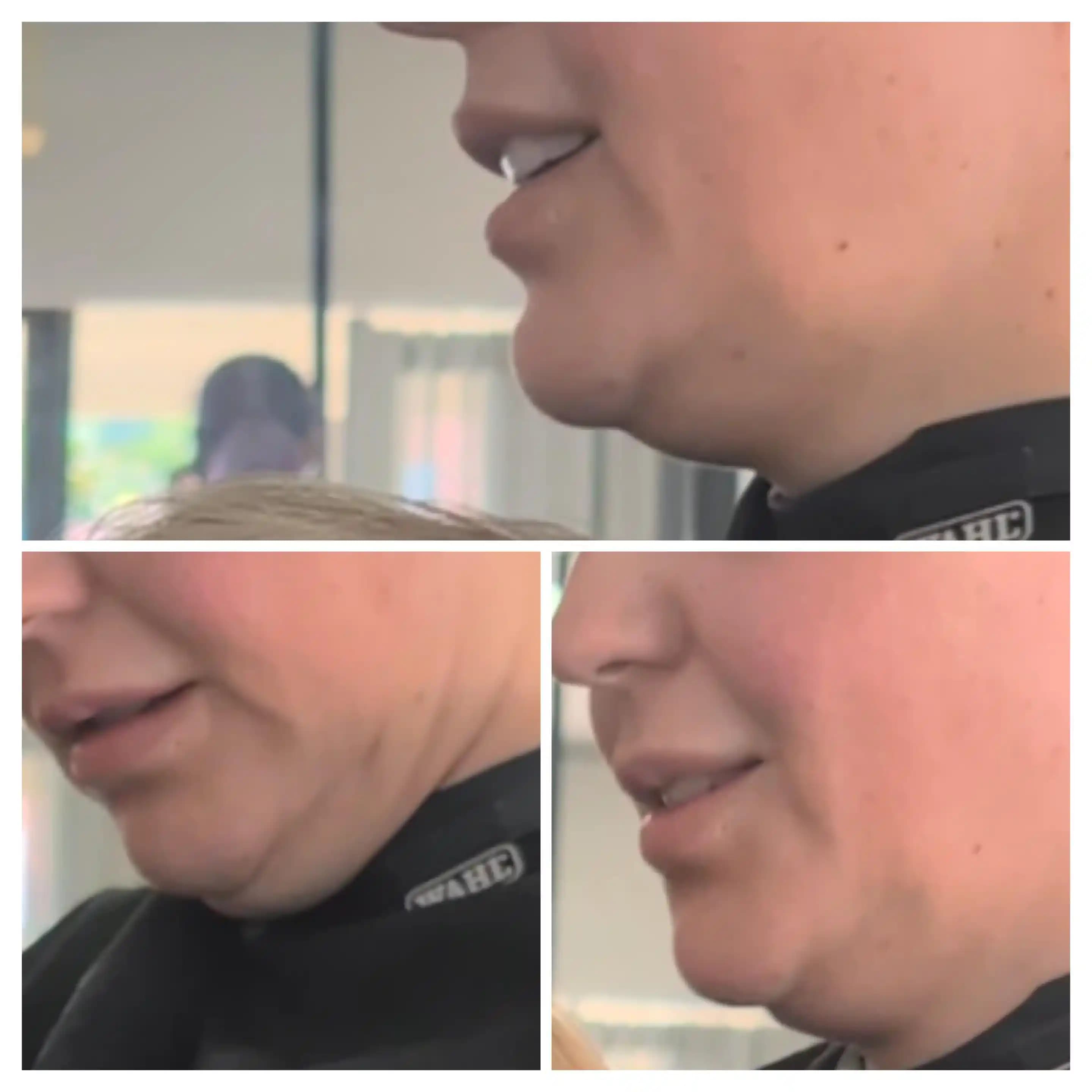 Çene ve Boyun Sarkmasını Gidermede Kilo Kontrolü, Egzersiz ve Estetik Yöntemler