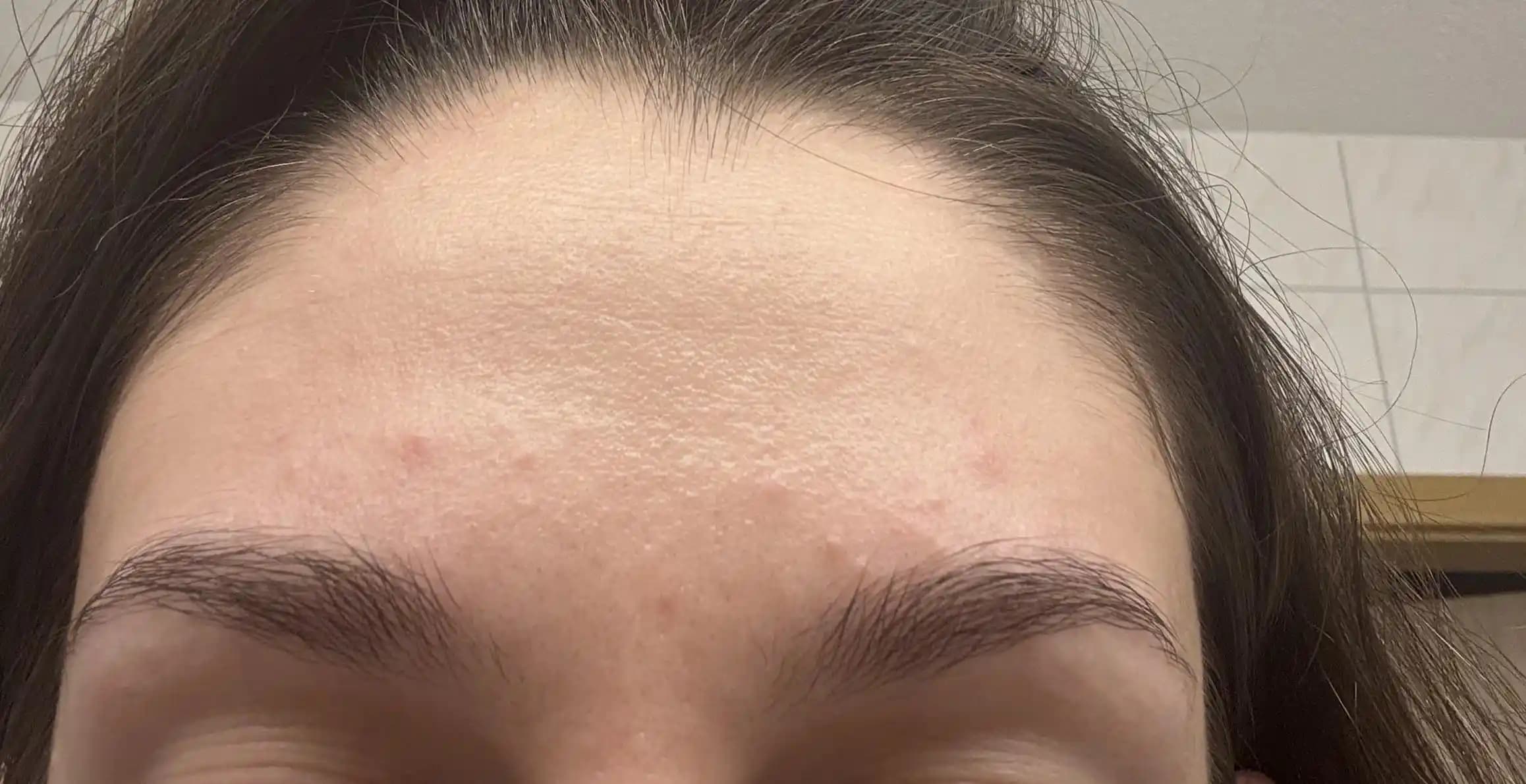 Ciltte Pürüz ve Tıkanmış Gözeneklerle Mücadelede Aktif İçeriklerin Rolü ve Bakım Önerileri