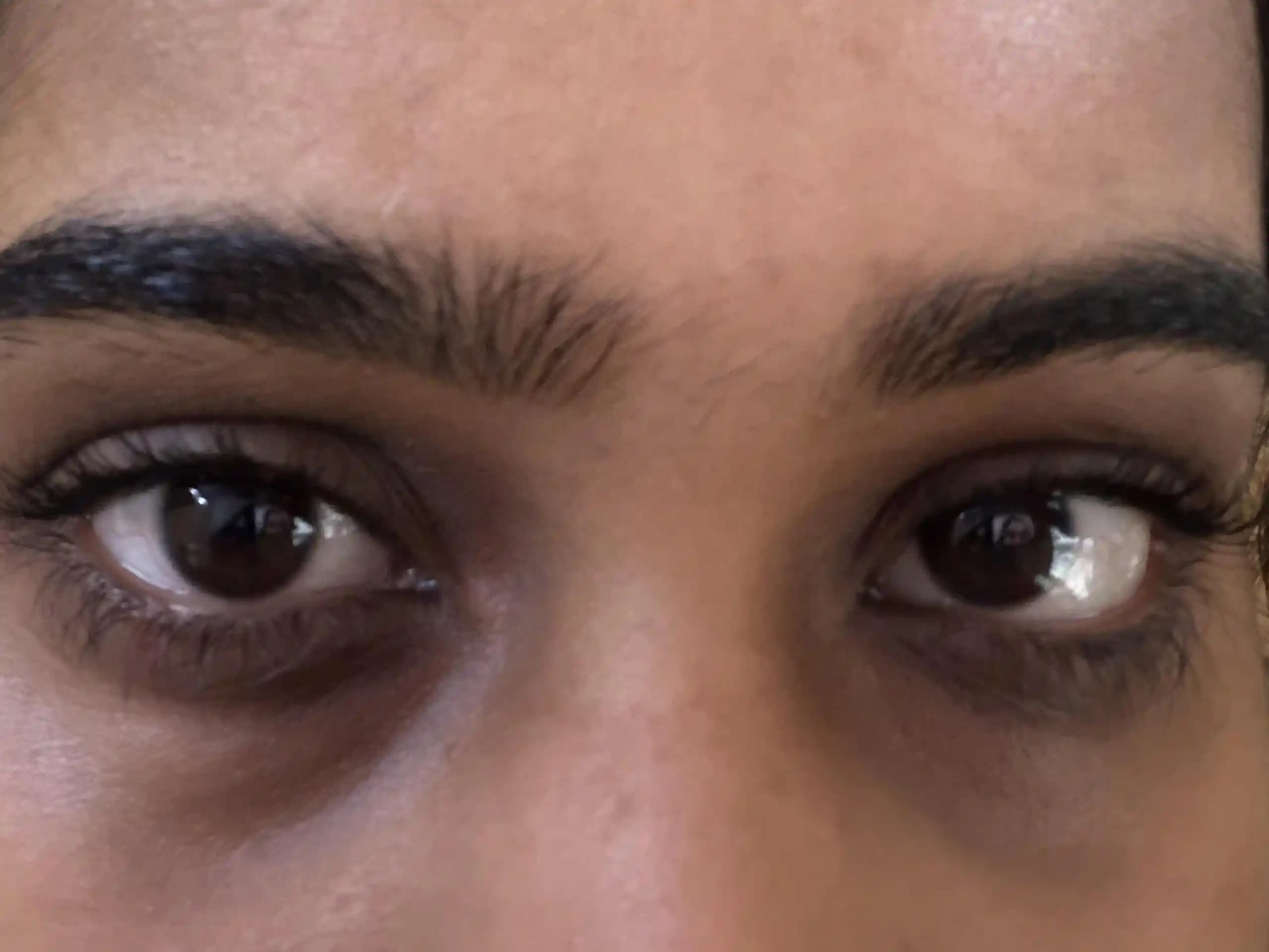 Göz Çevresindeki Hiperpigmentasyonun Nedenleri ve Etkili Tedavi Yöntemleri