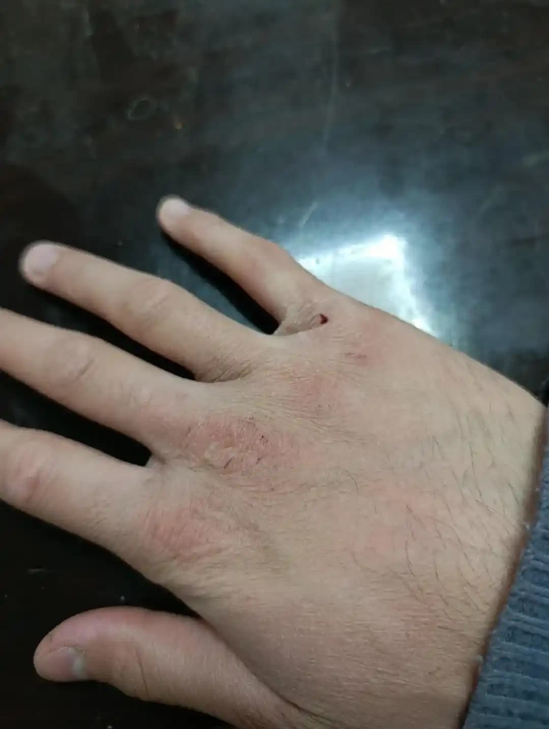 Kertenkele Derisi Gibi Kuru ve Çatlamış Eller İçin Etkili Onarım Yöntemleri ve Koruma