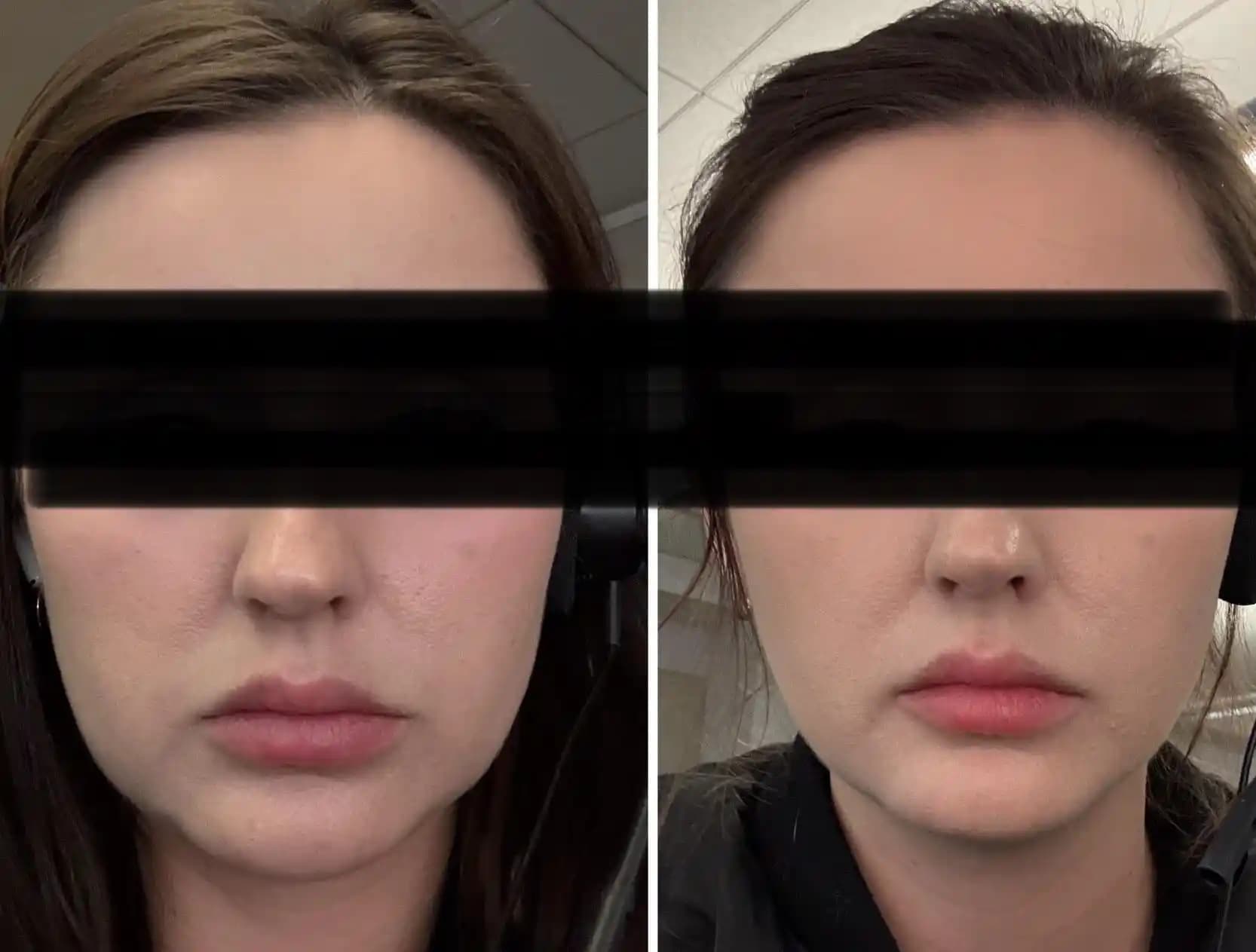 Masseter ve DAO Botox Uygulamaları: Etkileri, Riskleri ve Doğru Uygulama Yöntemleri