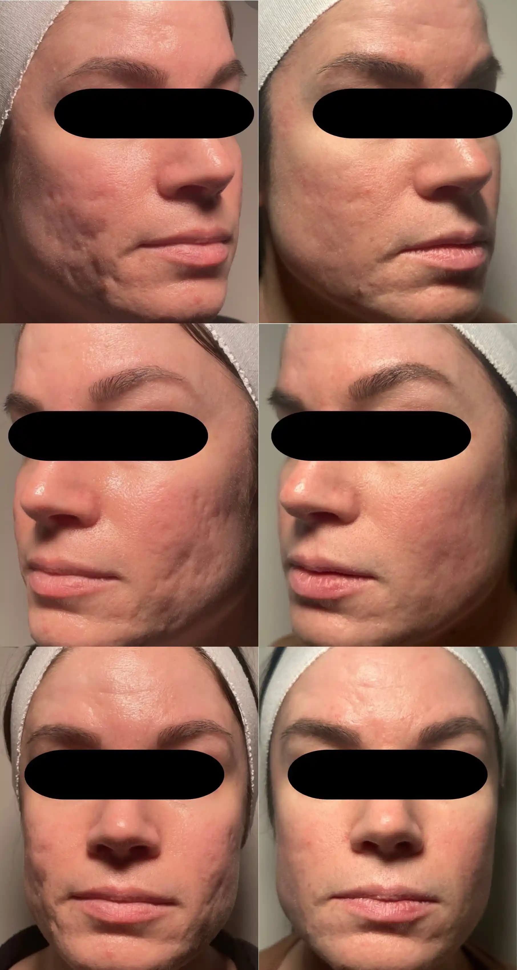 Tam Yüz Kombine Cilt Tedavisi: CO2 Lazer, Genius RF, Pickle Fork Subcision ve Sculptra Sonuçları