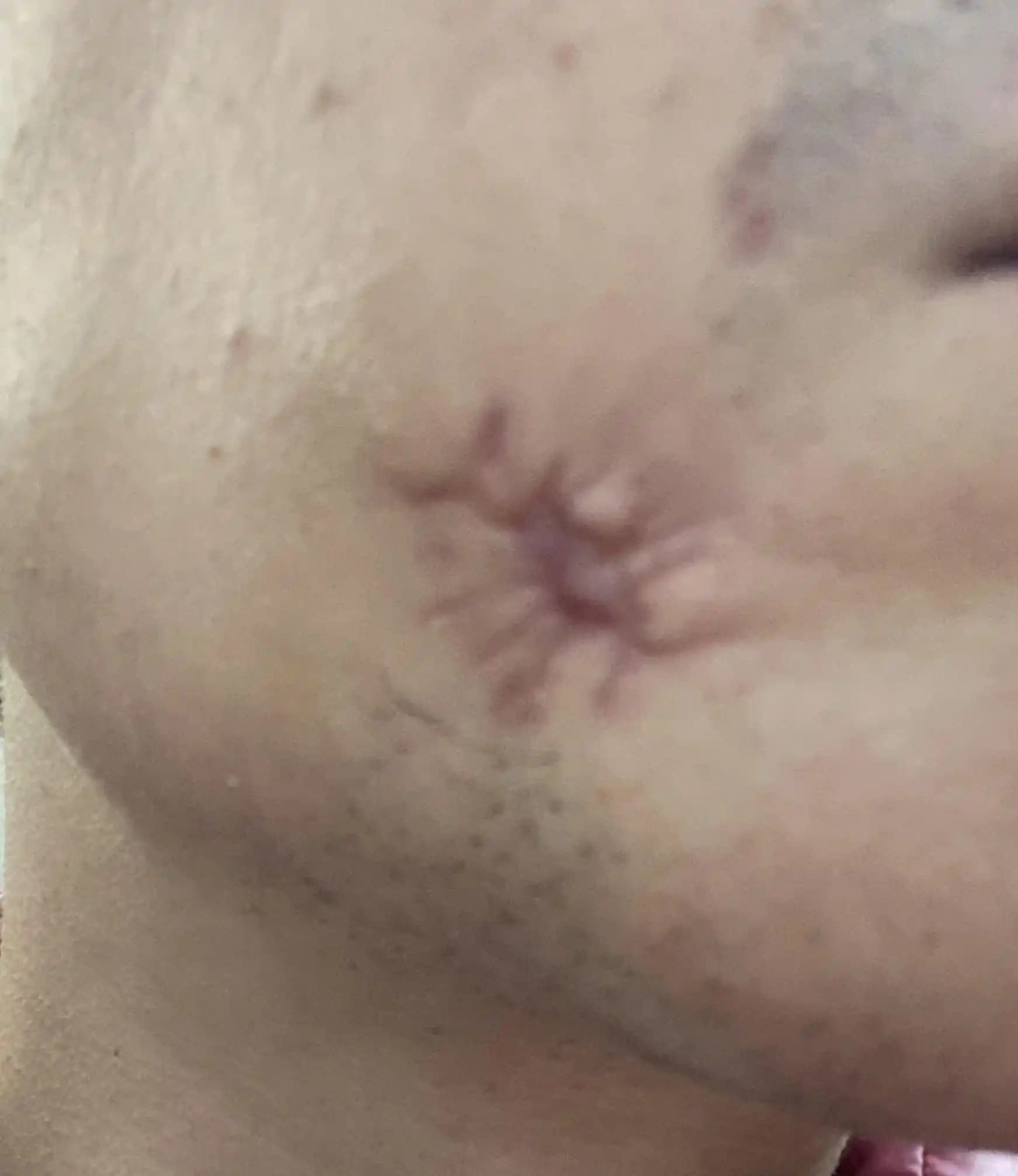 Yüzdeki Ameliyat İzlerinin Tedavisi: Lazer, Mikroiğneleme ve Cerrahi Yöntemler