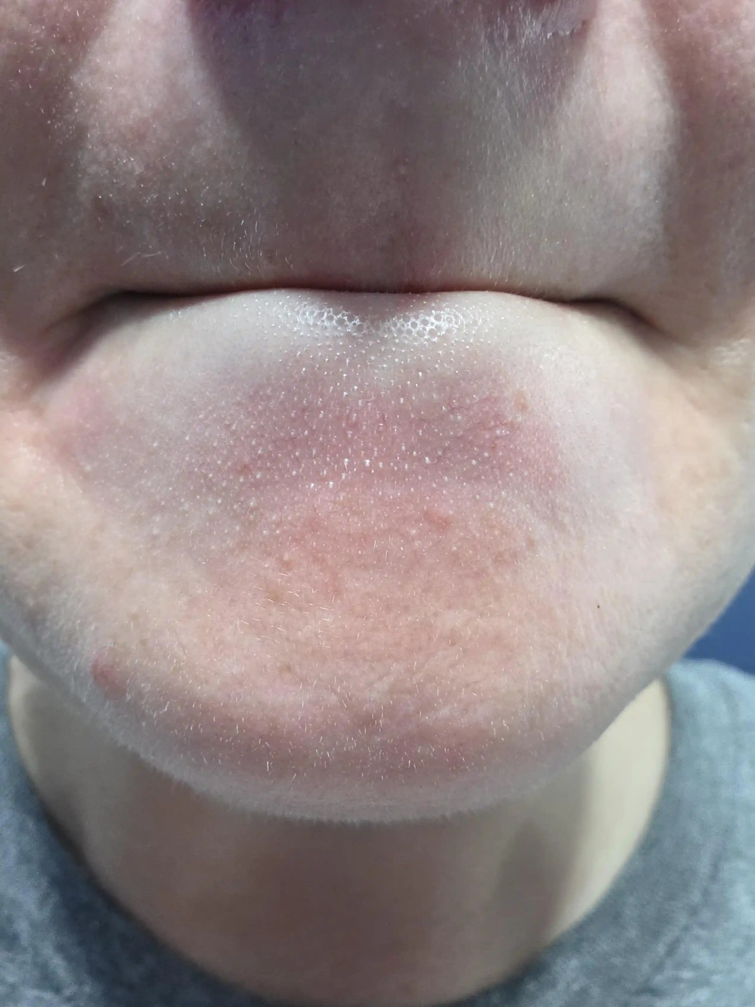 Yüzdeki Sebaceous Filamentler: Doğal Siyah ve Beyaz Noktaların Bakımı ve Azaltılması